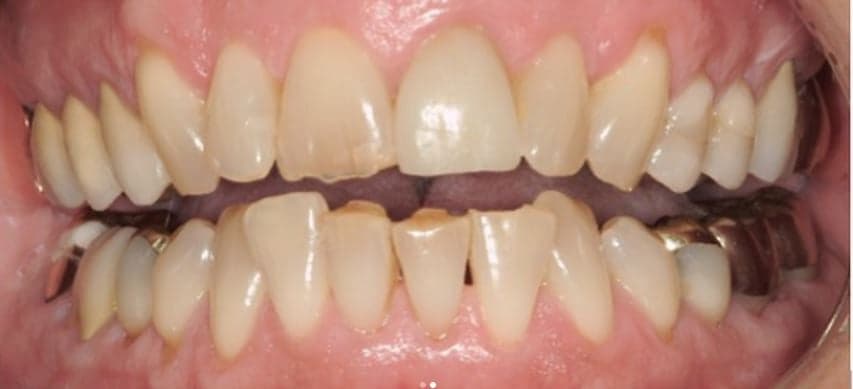 Patient smile transformation