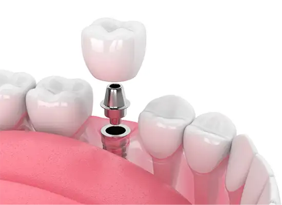 Dental Implants