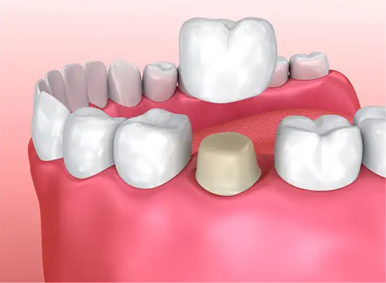 Dental Crowns & Bridges